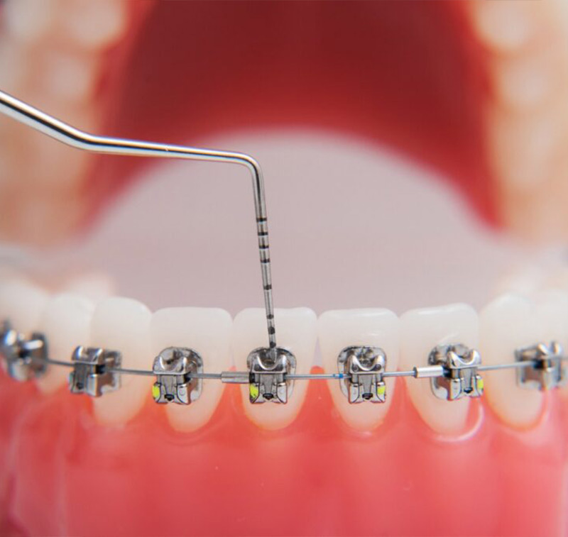 	 Best Orthodontic Treatment and Package